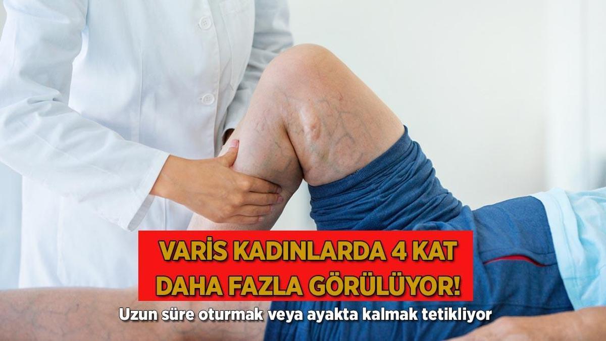 Uzun oturanı da ayakta kalanı da vuruyor! Bacakları damar damar saran varis için çare